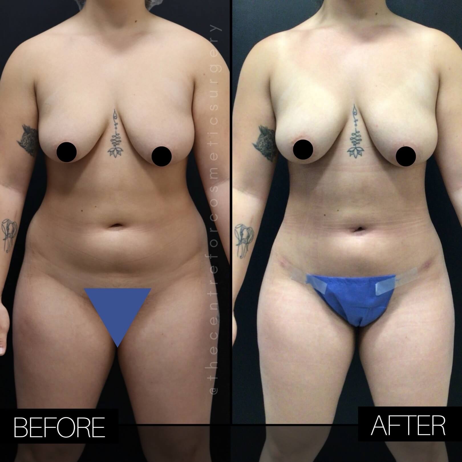 Liposuction Patient The Centre For Cosmetic Surgery