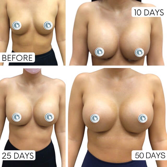 Breast Augmentation Patient The Centre For Cosmetic Surgery