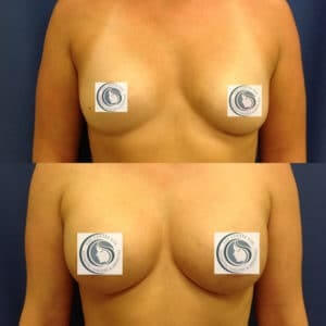 Before-and-After-Breast-Augmentation-Blog-300x300.jpg