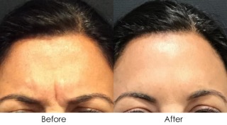 botox-before-after-1024x567.jpg