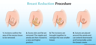 breast-reduction-procedure-diagram-1000-475.png