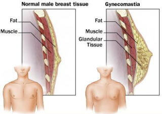 cross-section diagram comparing normal male breast tissue vs gynecomastia