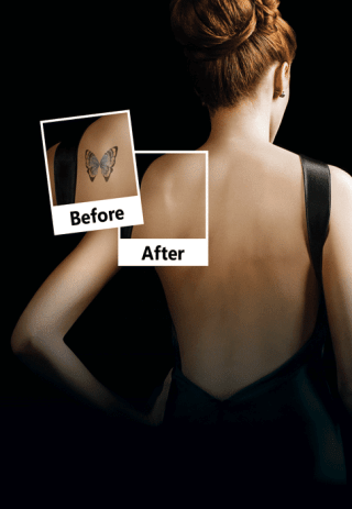 tattoo removal patient showing before and after butterfly tattoo on shoulder totally removed with no trace