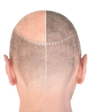 Hair Restoration patient showing bald head beside a region of undiminished follicle density