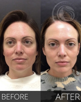 Laser Treatment #2133 Marge Image