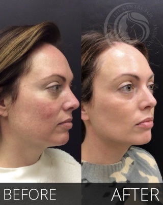 Laser Treatment #2133 Marge Image