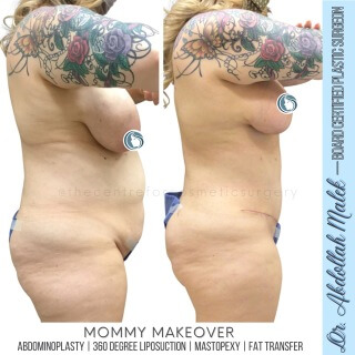 Tummy Tuck #9835 Marge Image
