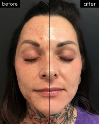 Laser Treatment #2982 Combined