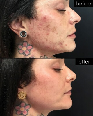 Laser Treatment #2982 Marge Image