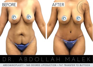 Tummy Tuck #3060 Marge Image