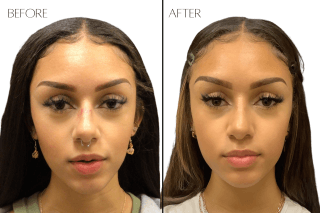 Rhinoplasty #2403 Marge Image