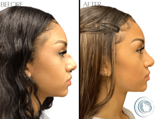 Rhinoplasty #2403 Marge Image