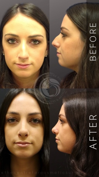 Rhinoplasty #4946 Marge Image