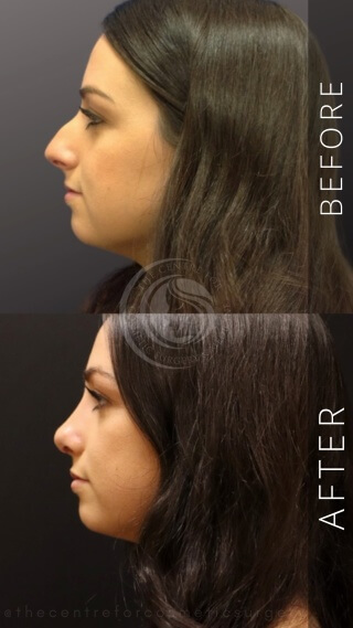 Rhinoplasty #4946 Marge Image