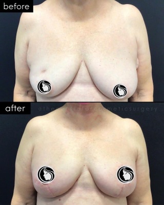Breast Lift #6310 Marge Image