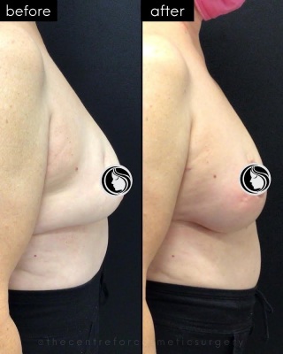 Breast Lift #6310 Marge Image