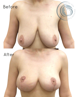 Breast Lift #9837 Marge Image