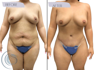 Mommy Makeover #3103 Marge Image