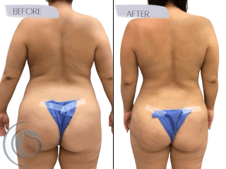 Mommy Makeover #3103 Marge Image