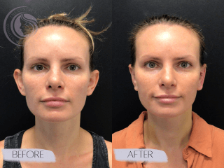 Otoplasty #6947 Marge Image