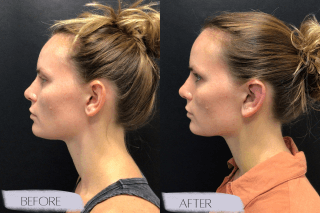 Otoplasty #6947 Marge Image