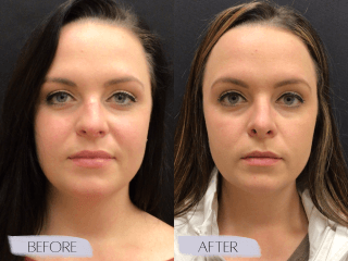 Rhinoplasty #8962 Marge Image