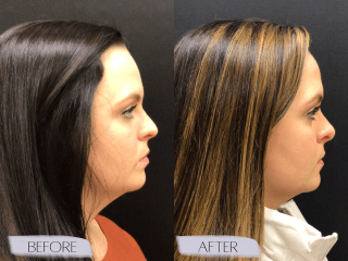 Rhinoplasty #8962 Marge Image