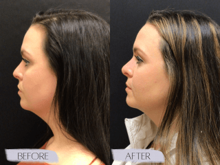 Rhinoplasty #8962 Marge Image