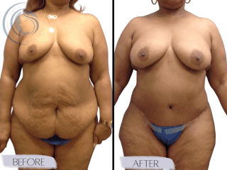 Tummy Tuck #4295 Marge Image