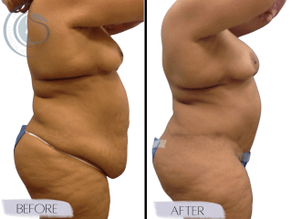 Tummy Tuck #4295 Marge Image