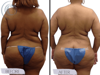 Tummy Tuck #4295 Marge Image