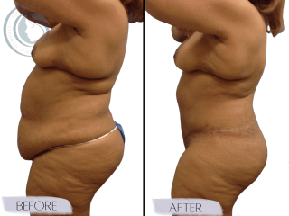 Tummy Tuck #4295 Marge Image