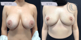 Breast Lift/Reduction #9689 Marge Image