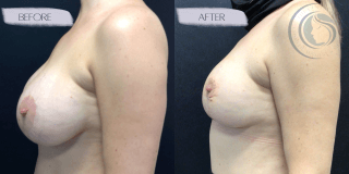 Breast Lift/Reduction #9689 Marge Image