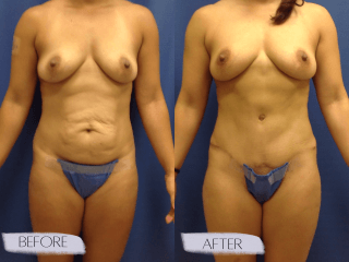 Tummy Tuck #8177 Marge Image