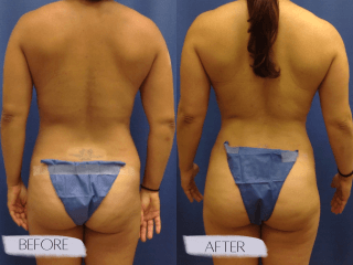 Tummy Tuck #8177 Marge Image