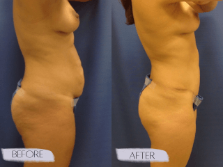 Tummy Tuck #8177 Marge Image