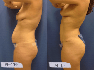 Tummy Tuck #8177 Marge Image
