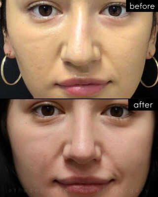Rhinoplasty #2290 Marge Image