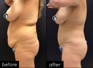 Tummy Tuck #8397 Marge Image