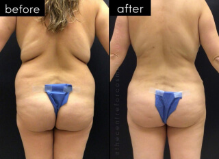 Tummy Tuck #8397 Marge Image