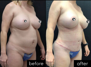 Tummy Tuck #8787 Marge Image