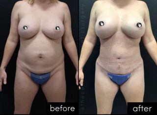 Tummy Tuck #8787 Marge Image