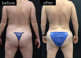 Tummy Tuck #8787 Marge Image