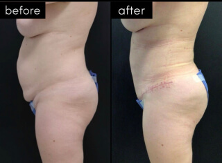 Tummy Tuck #8787 Marge Image
