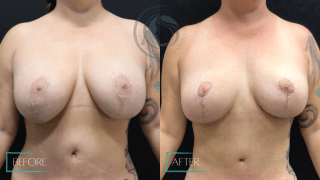 Breast Lift #9005 Marge Image