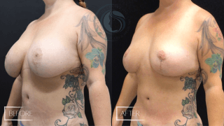 Breast Lift #9005 Marge Image