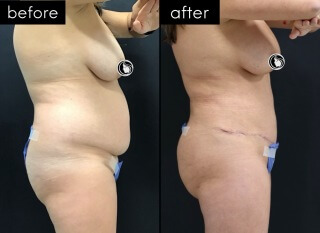 Tummy Tuck #3705 Marge Image