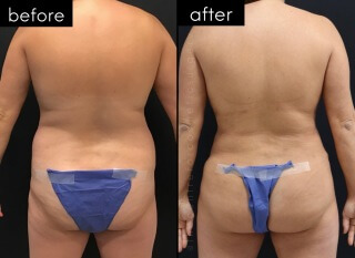 Tummy Tuck #3705 Marge Image
