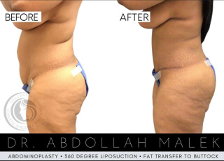 Tummy Tuck #3060 Marge Image